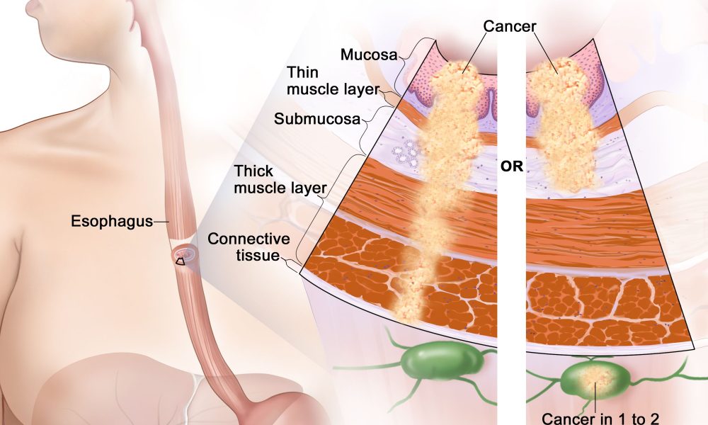 Išplečiamos stemplės vėžio gydymo galimybės, siekiant geresnių pacientų rezultatų